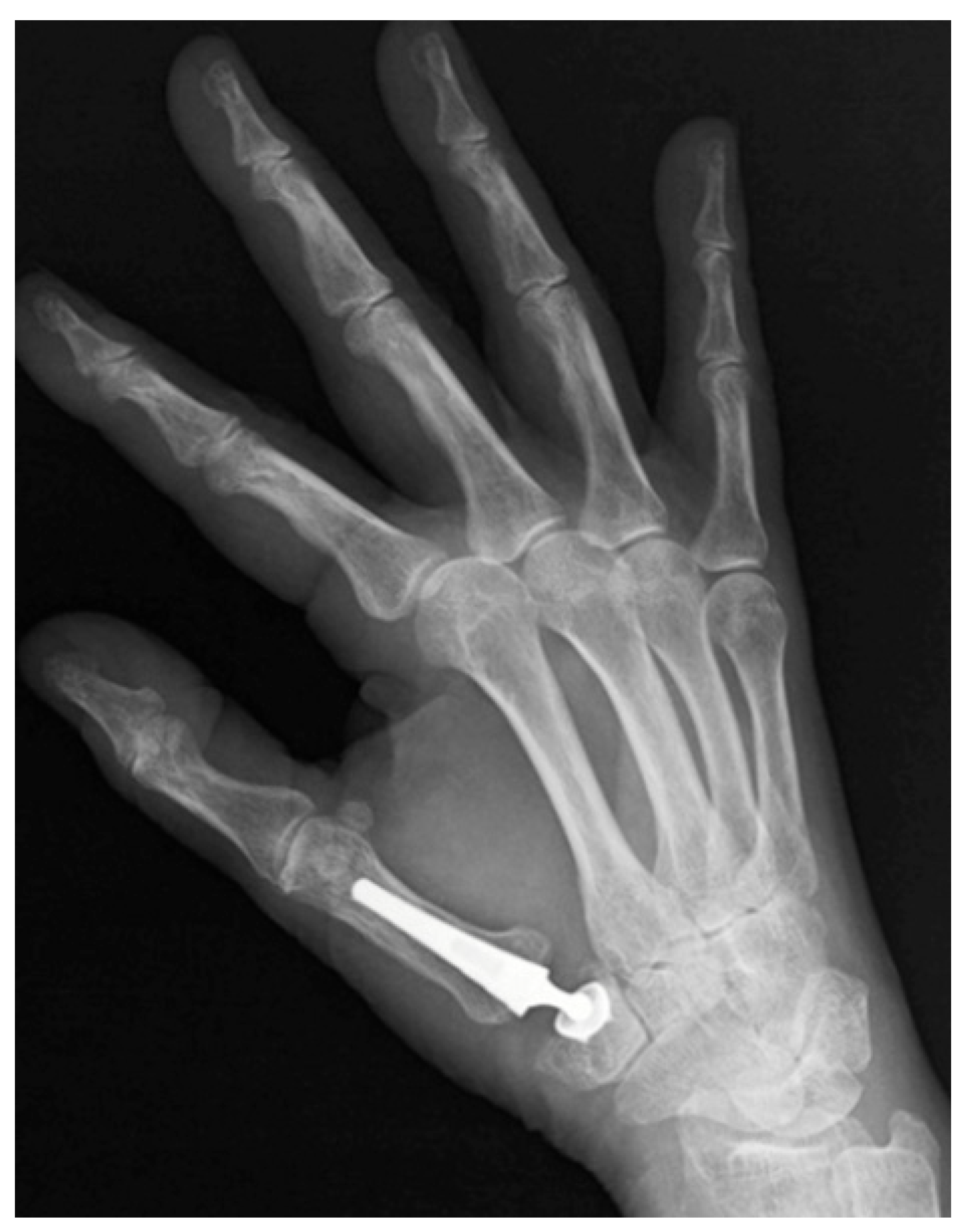 Röntgenfoto van een hand met een geplaatste MAÏA-duimprothese: de prothese is zichtbaar als witte componenten op de plek van het oude duimbasisgewricht.